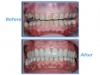 Mexico dental case: total mouth rehabilitation with zirconia crowns