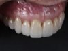 Cosmetic dentist for high quality veneers in Los Algodones, Mexico