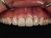 Dental Implants to fix smile on front teeth Los Algodones, Mexico