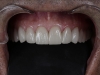 Thin Veneers, Prepless Veneers Los Algodones Dentist in Mexico