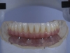 Implant supported Fixed Zirconia denture Mexico