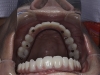 Full Mouth Dental Implants Picture Yuma Bordoer