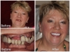 Full Mouth Restoration: Los Algodones, Mexico Before and After