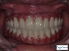 Full upper and lower dental implants in Tijuana