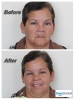 Implant Supported Dentures - Overdentures in Tijuana