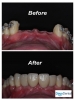 Cosmetic dentistry using dental implants