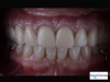 Fixed Bridge Supported by Dental Implants