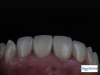 CAD/CAM All Porcelain Crowns in Tijuana