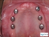 All on 6 Dental Implants Tijuana dentist in Mexico