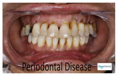 Sample Image Periodontal disease