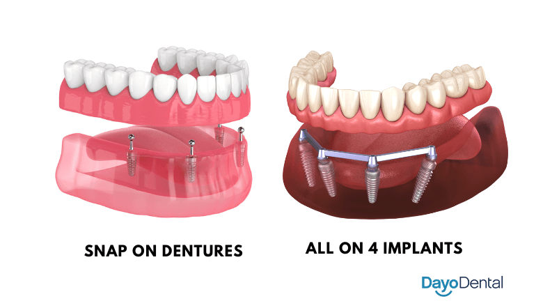 Snap on Dentures vs All on 4 Dental Implants: A Comprehensive Guide